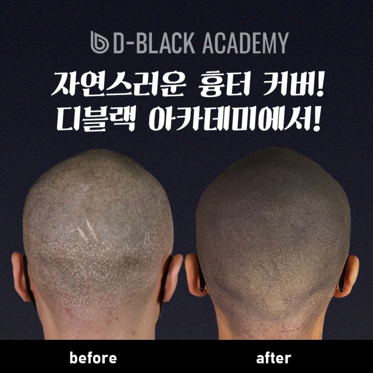  오산smp잘하는곳 :: 흉터 탈모관리 디블랙 아카데미 오산점