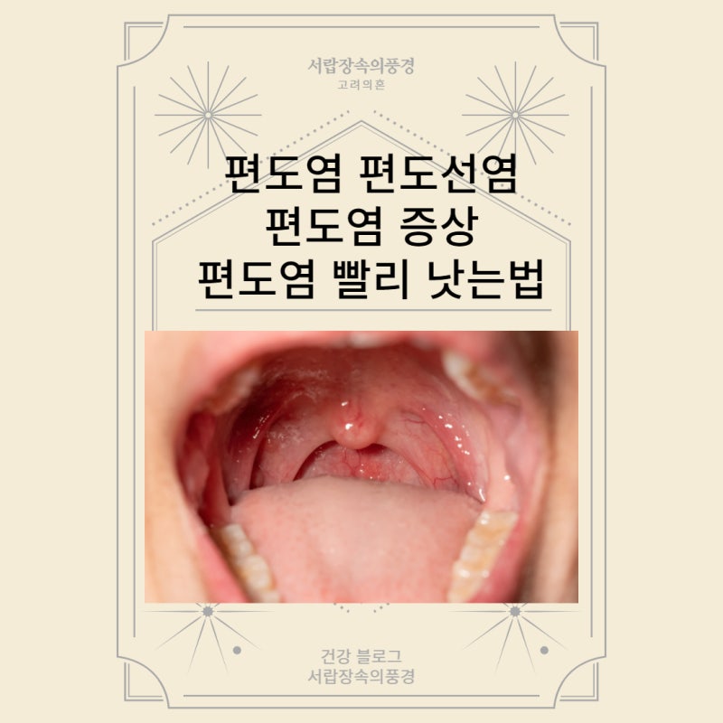 sore throat crossroads, sore throat, tonsillitis, antibiotic analgesic anti-inflammatory vs probiotics propolis