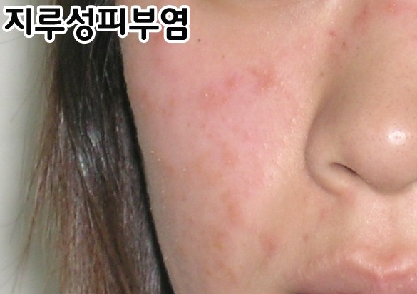 지루성 피부염 원인, 증상, 관리, 이해와 치료법(증상에 좋은 로션 추천)