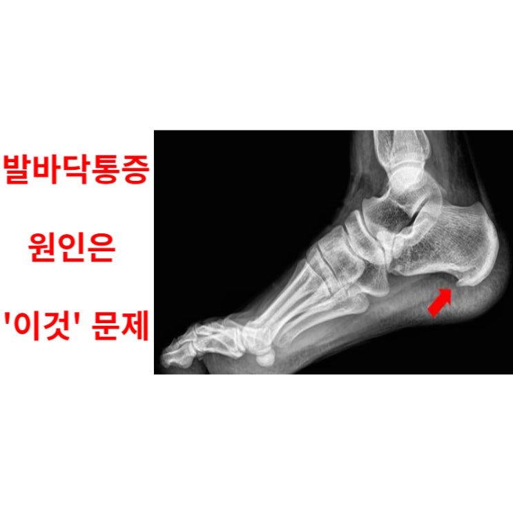  광주족저근막염, 치료에 대해 현직 의사가 말씀드립니다