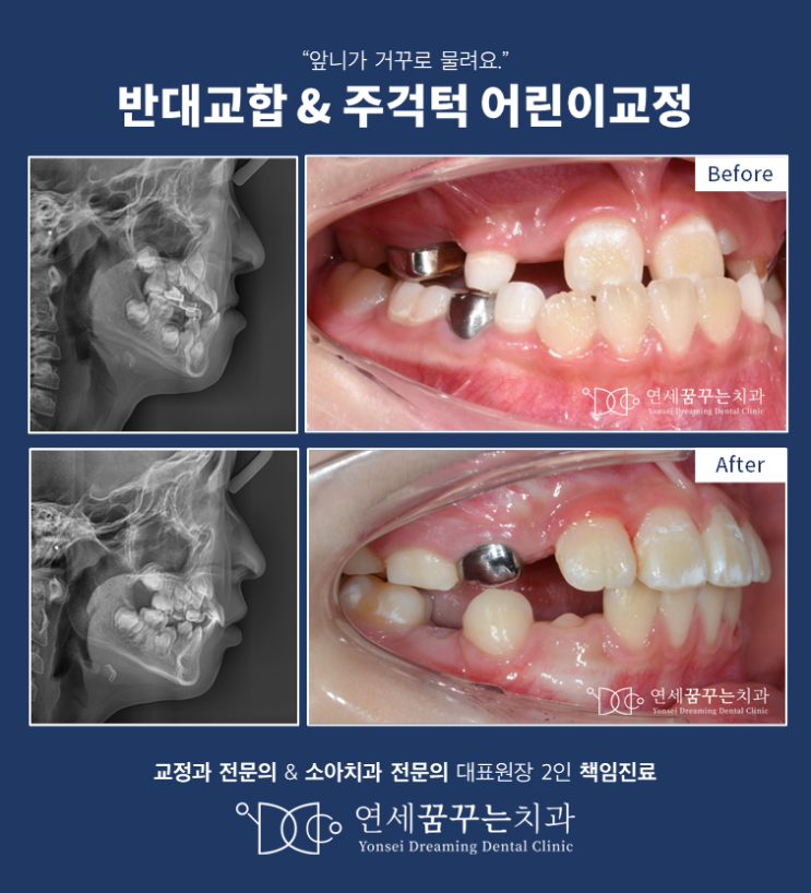 어린이 반대교합 주걱턱 부정교합 치료 시 주의사항