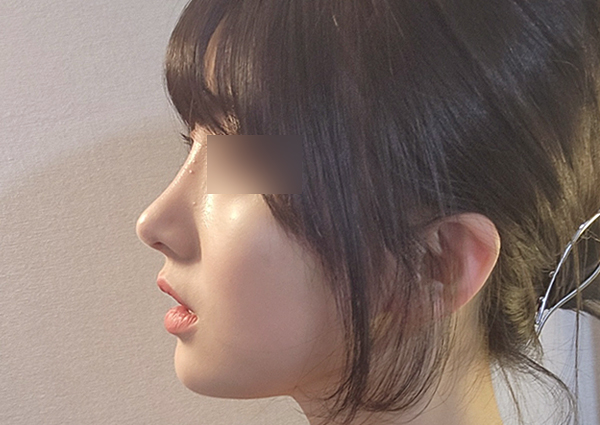  비순각교정 후 콧구멍 모양은 어떻게 변하나요??(강남성형외과)