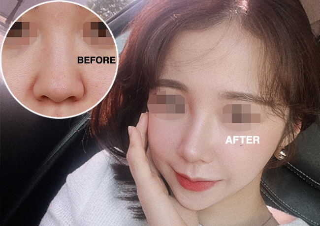  복코수술 후, 또렸해진 이미지(압구정성형외과)