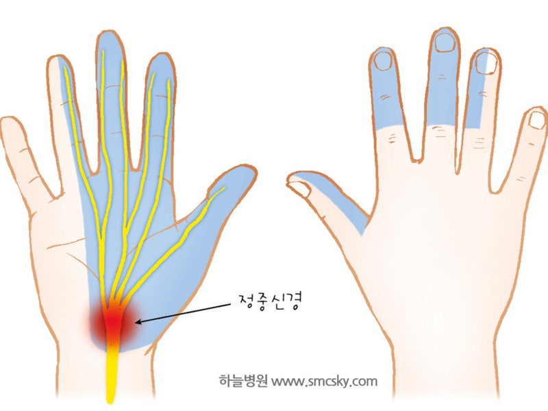 손목터널증후군 증상 및 치료(손목 통증, 손저림 원인, 운동, 테이핑 방법)