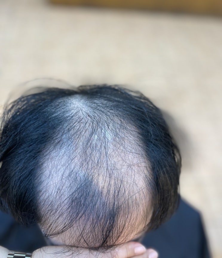  경상남도김해에서 왔어요 이마정수리 탈모심함 남자탈모성형펌 -부산사상르네시떼미용실/부산미용사상미용감전미용괘법미용덕천미용화명미용서면미용주례미용동래미용사직미용금정미용김해미용경남미용진주