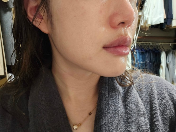 인천 구월동 피부과 얼굴살 없어도 가능한 구월동 리프팅 리프테라 후기 인천 구월동 피부과 얼굴살 없어도 가능한 구월동 리프팅 리프테라 후기