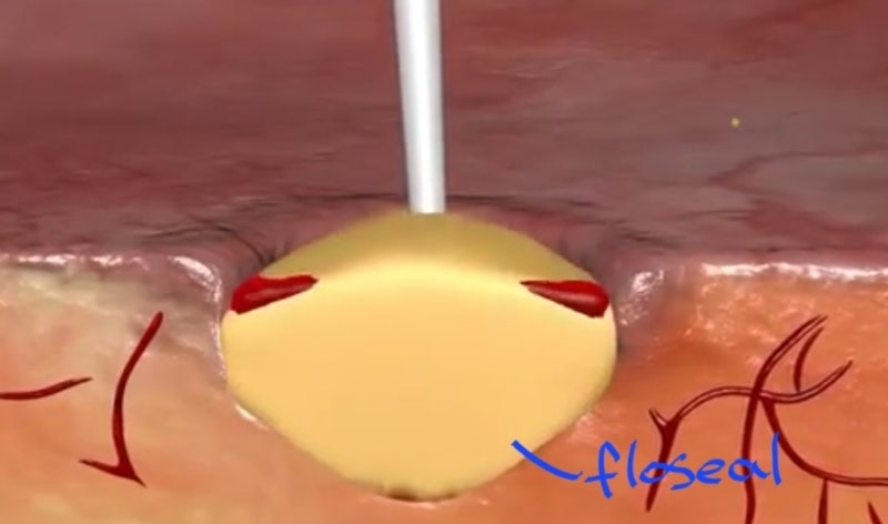 수술실스크럽간호사 -수술시 사용하는 지혈제 종류 1 - surgicel (써지쎌) . Tiseal , floseal, bone ...