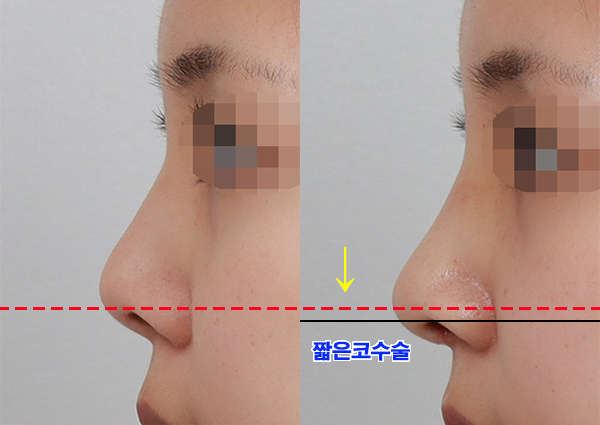  짧은코수술, 전후 효과 확실하게!(신사역성형외과 치유)