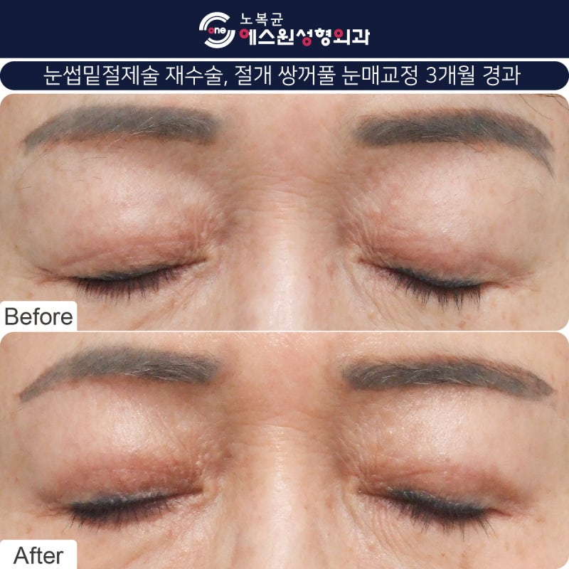 압구정역 성형외과 눈썹큰수술 어버이날 효도선물 3