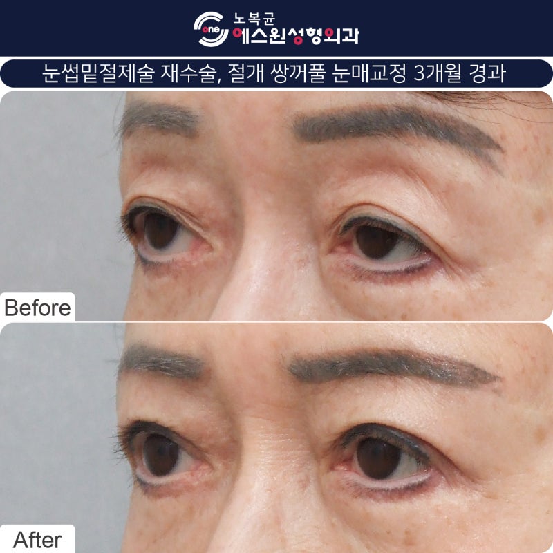 압구정역 성형외과 눈썹큰수술 어버이날 효도선물 2