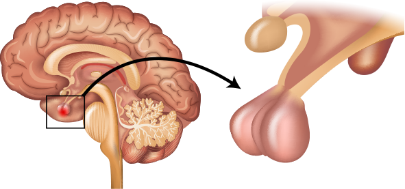 뇌하수체종양의 이해