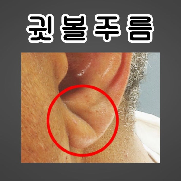  대각선 귓볼주름 치매 뇌졸중 프랭크싸인
