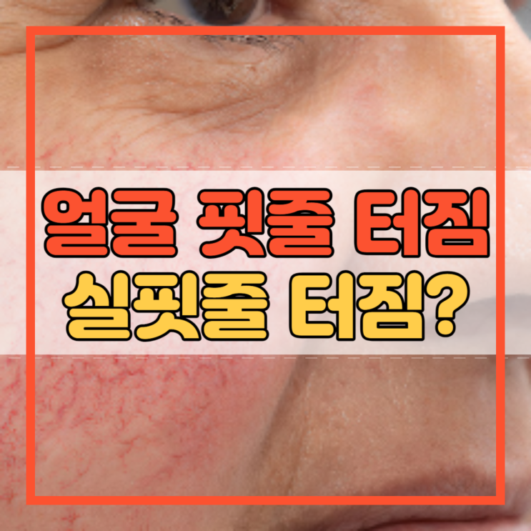  얼굴 핏줄 터짐 실핏줄 원인과 예방법!