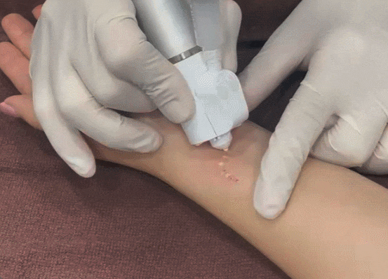 해운대 흉터 완벽하게 제거? 절대 믿지 마세요 해운대 흉터 완벽하게 제거? 절대 믿지 마세요