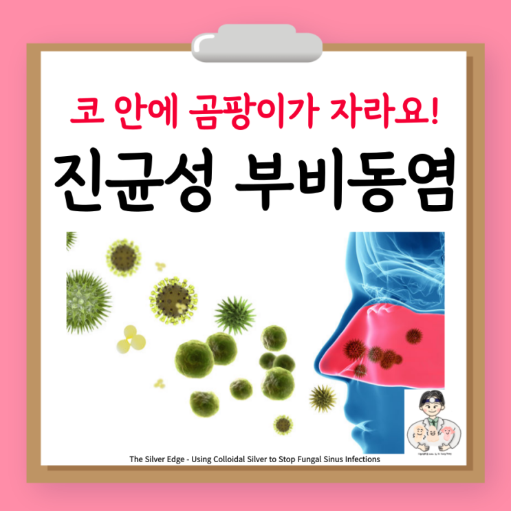  진균성 부비동염, 곰팡이성 축농증, 분류 특징 증상 검사 치료 수술