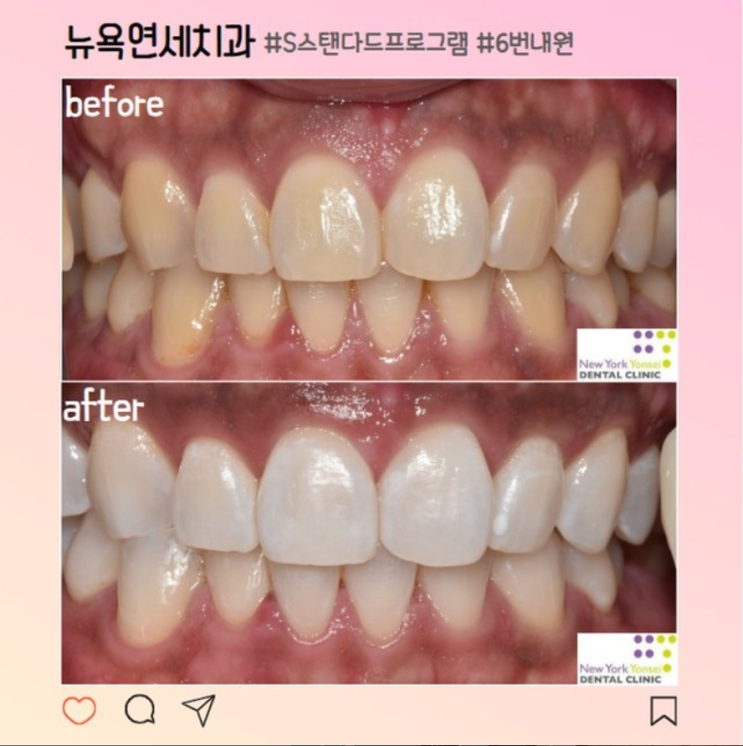 [강남역 치아미백] 치과 치아미백 부작용 없이 효과 좋은 곳 추천
