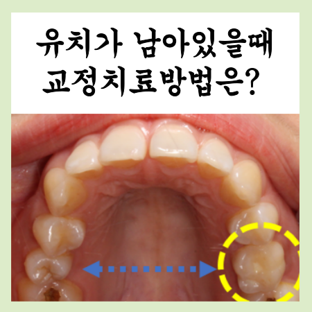  은행사거리 교정치과, 유치가 남아있을때 방법은?