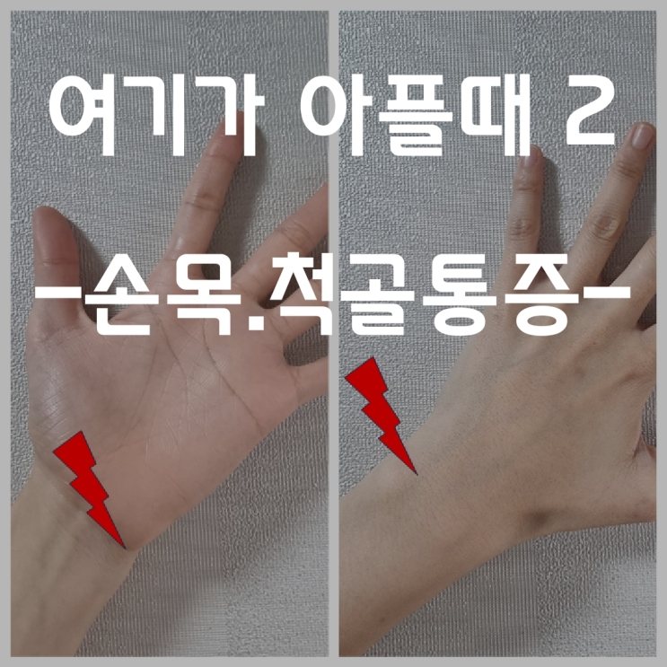 [재활의학과] 새끼손가락 쪽 손목통증 (척골충돌증후군, 삼각섬유연골복합체 통증) -1- 증상과 원인