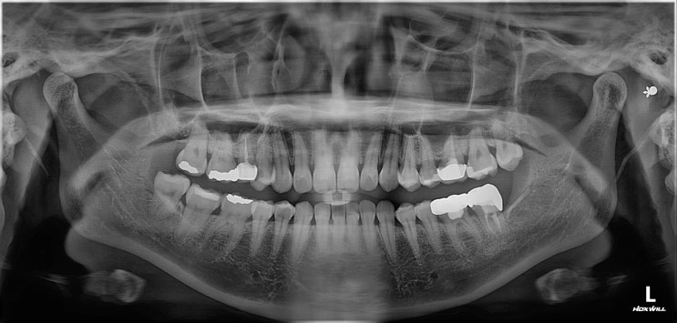 [임상] 심한 충치 치아 신경치료 & 크라운