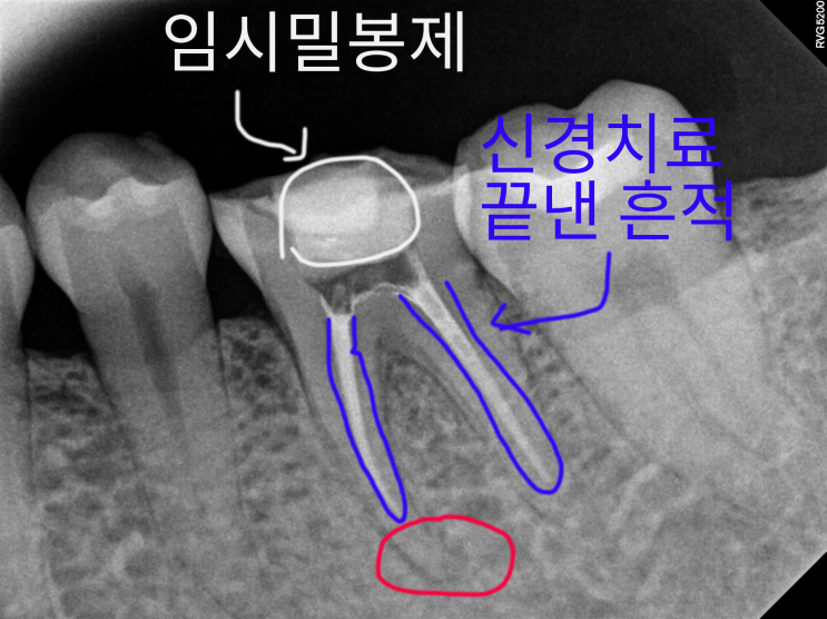 [임상] 치아가 아파요 (신경치료)