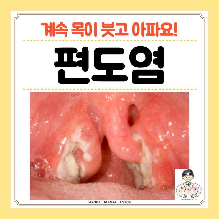  급성 만성 편도염 편도선염, 원인 증상 치료 약 수술