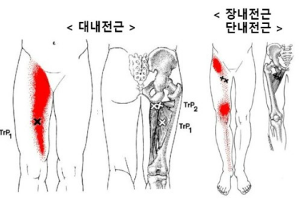 무릎/허리 통증을 유발하는 모음근(내전근)의 트리거포인트(통증유발점) 마사지법/활성화운동