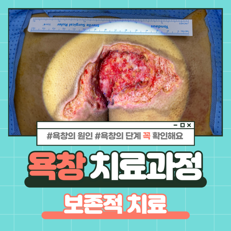  [욕창] 욕창의 원인과 욕창의 단계, 치료과정을 알아봅시다. (feat. 욕창의 보존적 치료, 음압드레싱, 피부이식술, 국소피판술 치료경과)