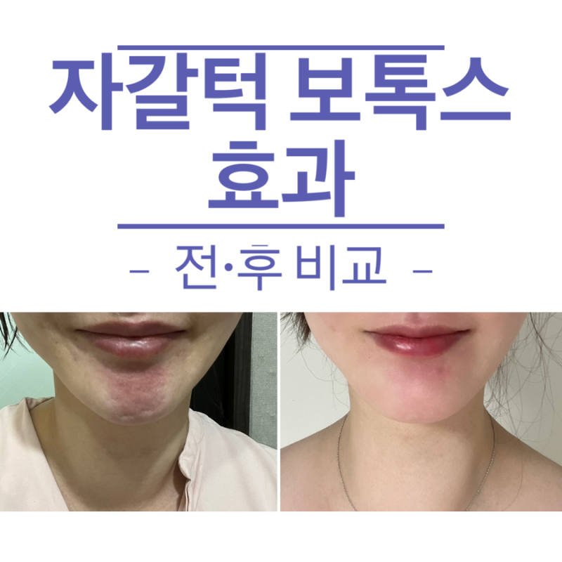 서울 피부과 자갈턱 보톡스로 미운턱주름 호두주름 없애기 내돈내산 후기 : 네이버 블로그