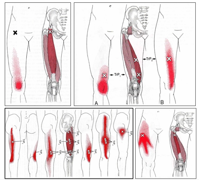 무릎 통증을 유발하는 대퇴사두근(넙다리네갈래근)의 트리거포인트(통증유발점) 근육들 특징, 다이어트, 마사지법, 추천 운동