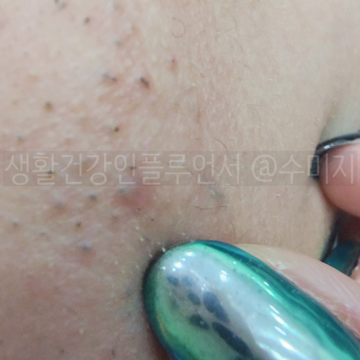  모낭염 원인 연고 모낭염 약 무피로신 : 얼굴 가슴 등 다리 모낭염 항생제