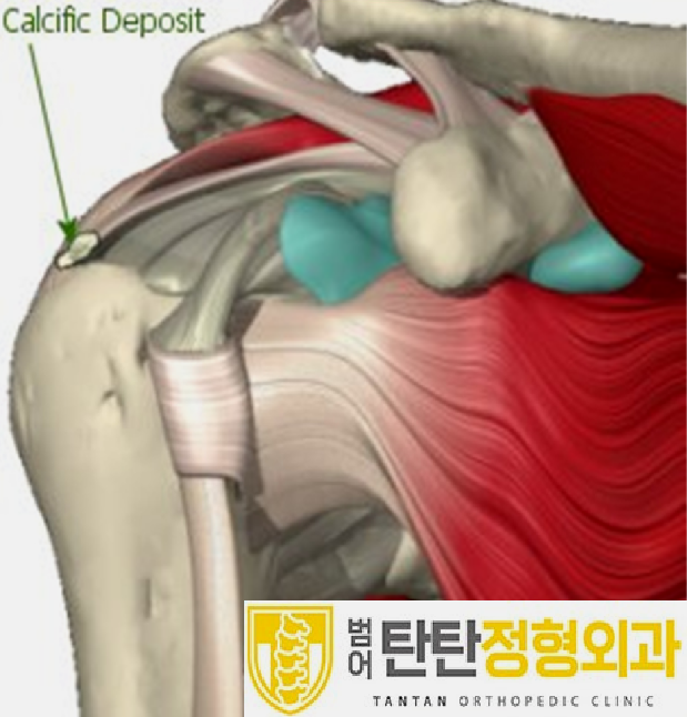  대구 체외충격파 석회화건염에 효과적이다?