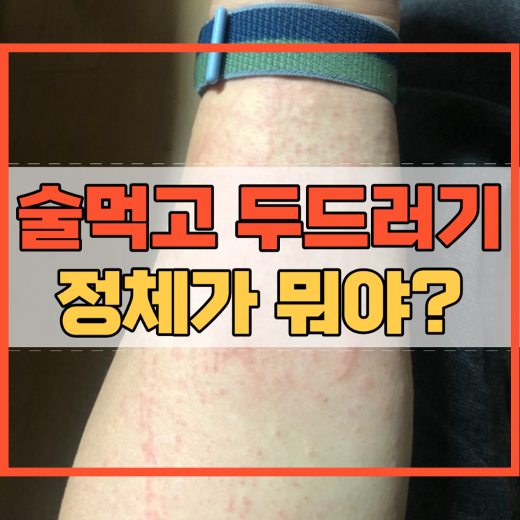  술먹고 두드러기 나타나는 이유 알고 계세요?