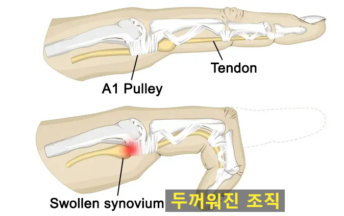  손가락 딸깍거려요! 수술없이 방아쇠수지 치료법은? 부산 실제사례