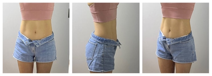  [ 지방분해주사 효과, 부작용 ] 복부 지방분해주사 10개월차