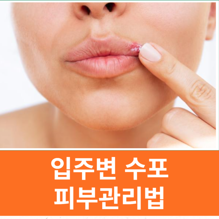  입주위 수포 원인 헤르페스 치료방법