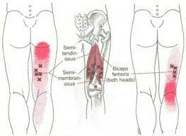 무릎 통증을 유발하는 햄스트링(뒤넙다리근)의 트리거포인트(통증유발점)마사지법, 운동방법, 부상 예방법