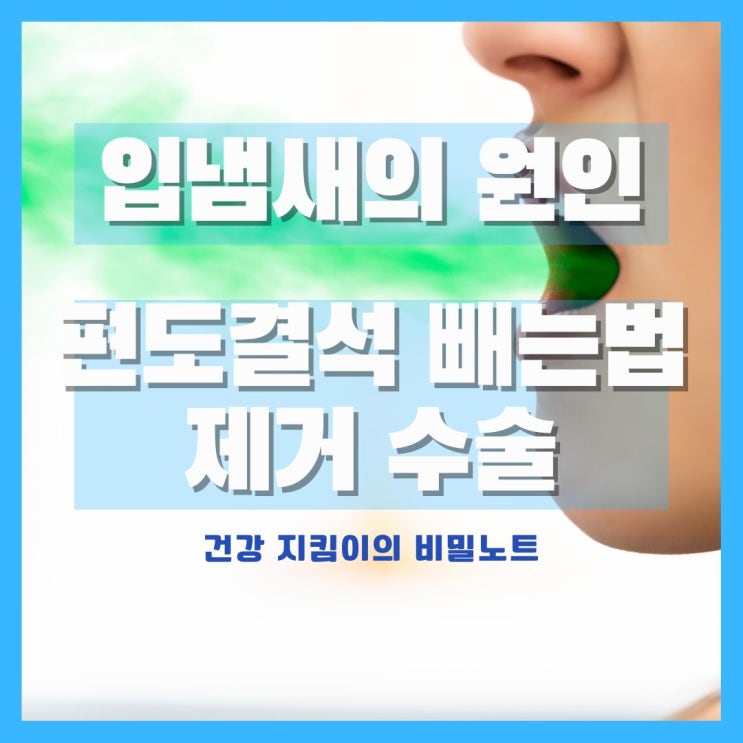  입냄새 원인 편도결석 빼는법, 편도결석 제거 수술