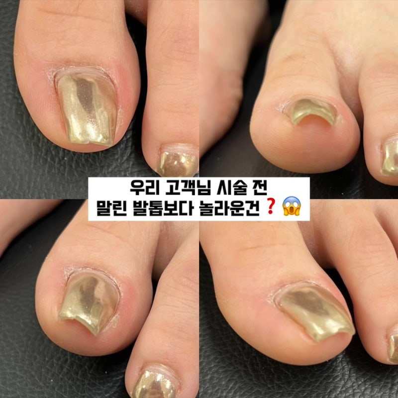 광주내성발톱병원 다녀왔는데 샵방문해주신 이유