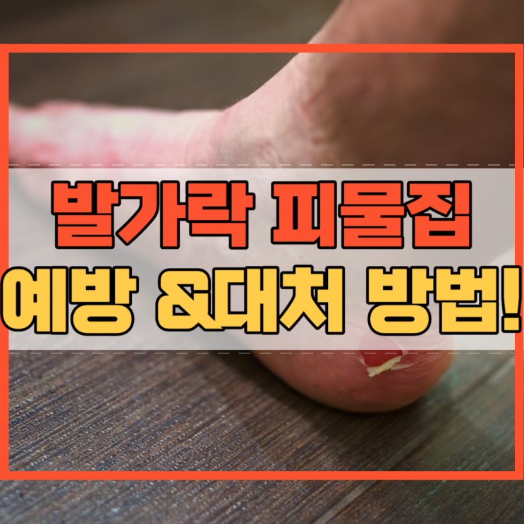  발가락 피물집 예방 및 대처 방법!