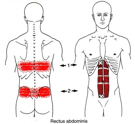 허리 통증을 유발하는 복직근(배곧은근), 복횡근(배가로근)의 트리거포인트(통증유발점)와 마사지, 운동방법
