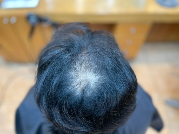  하남자에서 상남자로 남자탈모성형펌 부산유일무이탈모전문사상르네시떼헤어/ 덕포주례감전하단김해가야동래양산연산연지장전명륜대연양정서면망미초읍남포남천초장수정감만범일범내문현해운대장유기장정관