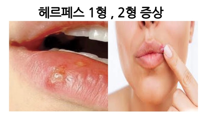 헤르페스 1형 2형 비교 교차감염 증상 원인 완치 가능성