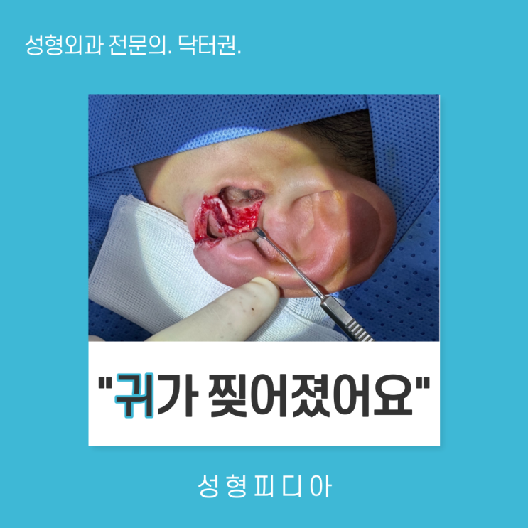[귀열상] 귀가 찢어졌어요. (feat. 일차봉합술, 귀연골 봉합술)