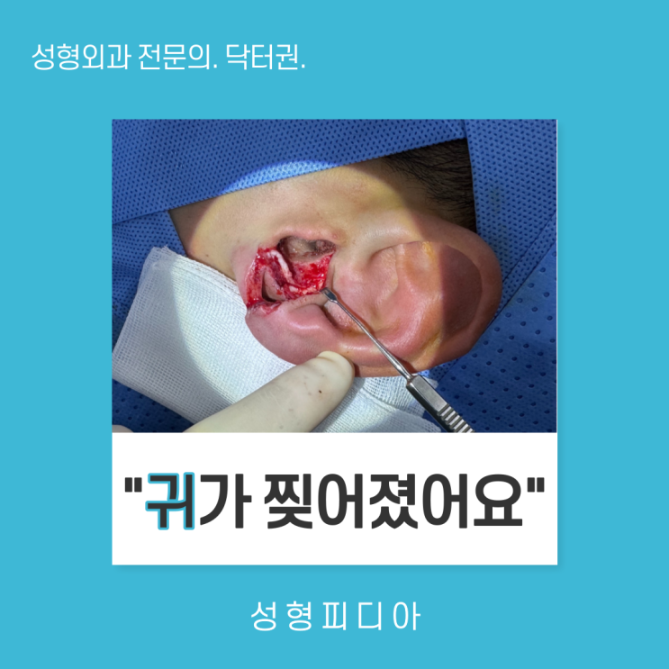  [귀열상] 귀가 찢어졌어요. (feat. 일차봉합술, 귀연골 봉합술)