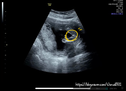 [12주-16주]<b>1차</b>기형아검사... 철분제(헤모큐 수), 성별 <b>아들</b>?딸?