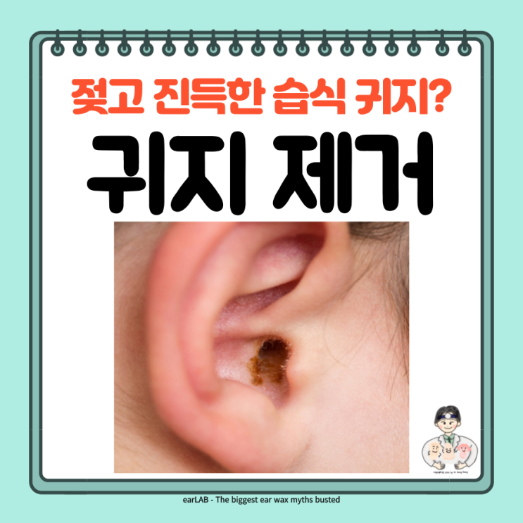  이비인후과 귀지 제거 귀 청소, 젖은 습식 귀지