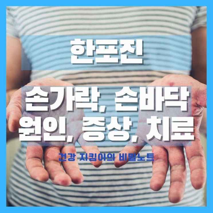  손바닥, 손가락 한포진 원인과 증상, 치료