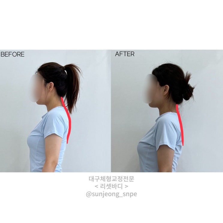  [대구 SNPE 리셋바디] 라운드숄더 교정 / 대구 체형교정 / 대구 목디스크운동