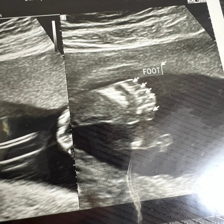 임신 6개월, 21주 정밀검사 후기