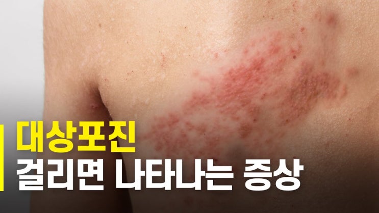  대상포진: 원인부터 치료까지 알아보는 완벽 가이드